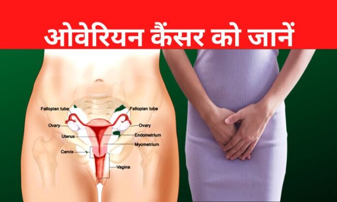 Ovarian cancer